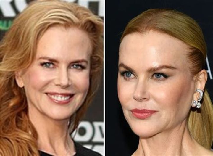 Nicole Kidman: The Truth Behind Her Plastic Surgery Journey